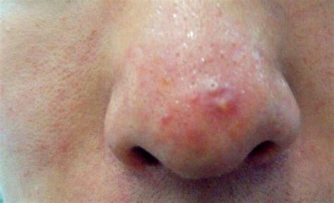 鼻子長痘痘代表什麼
